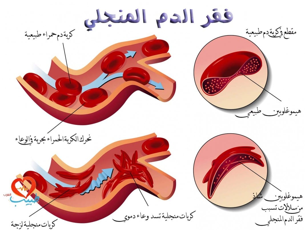 sickle-cell-anemia